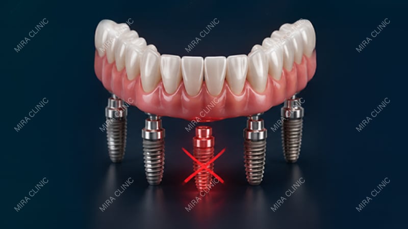 What Happens If One Implant Fails?